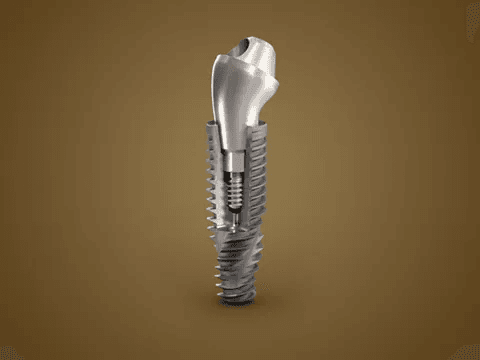 Neodent implant treatment