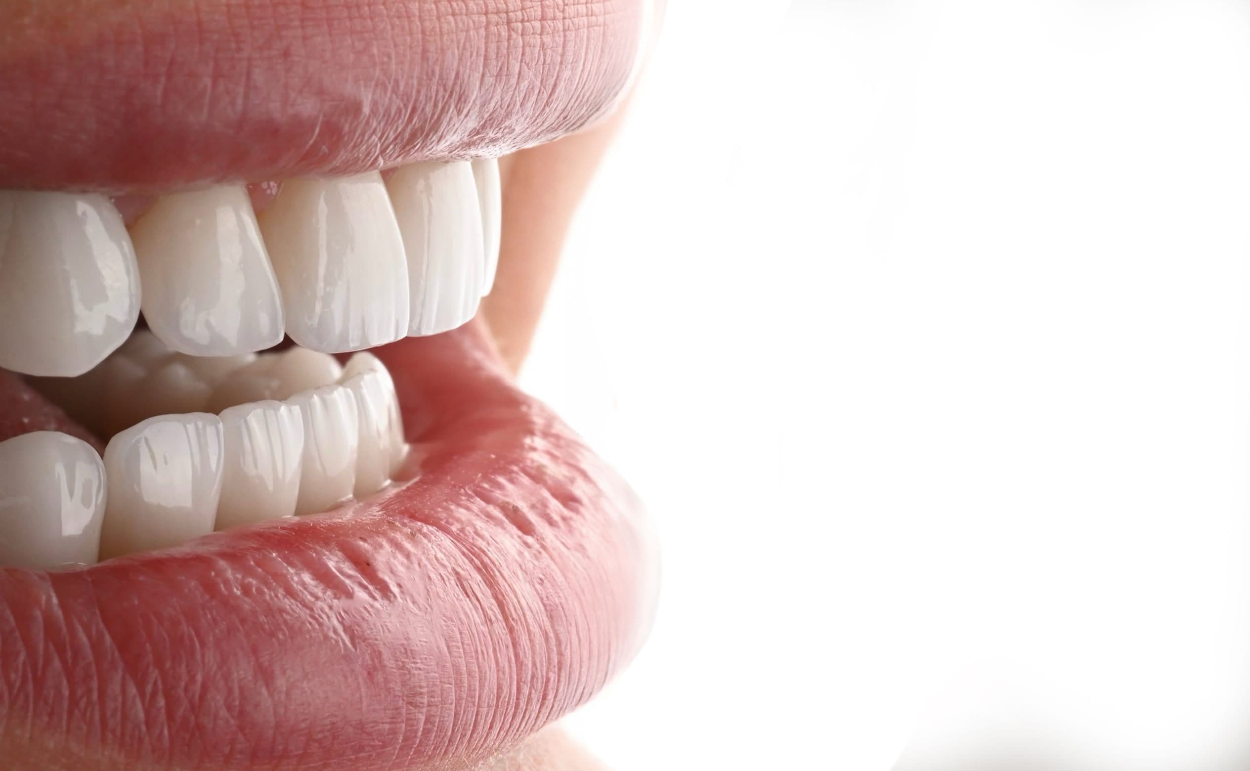 E-max veneers