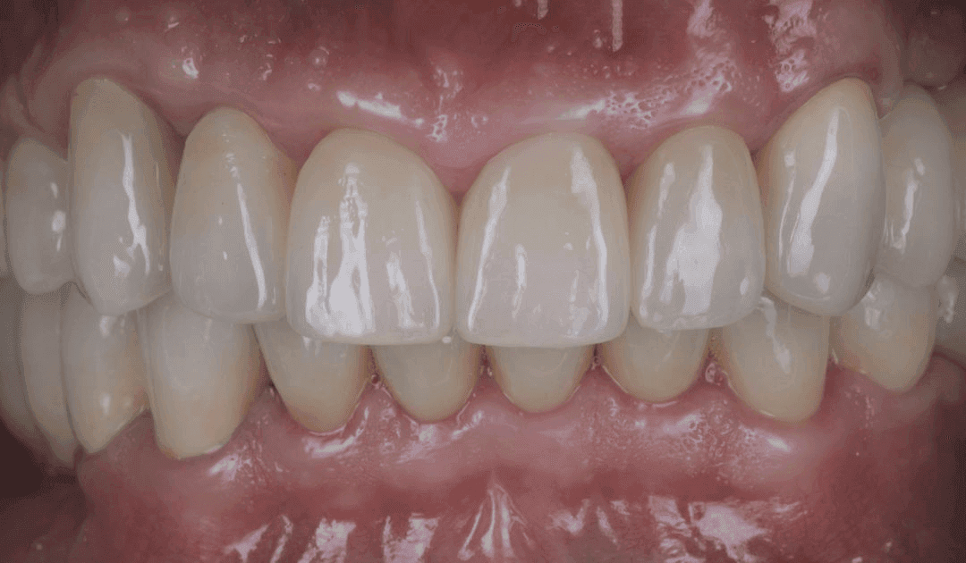 Aesthetic treatment result — a healthy white smile